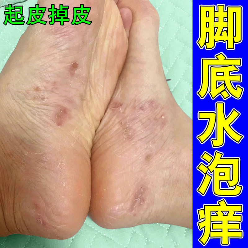 脚底水泡痒干燥粗糙起皮掉屑脚又痒又脱皮长小红点真菌脚痒专用膏