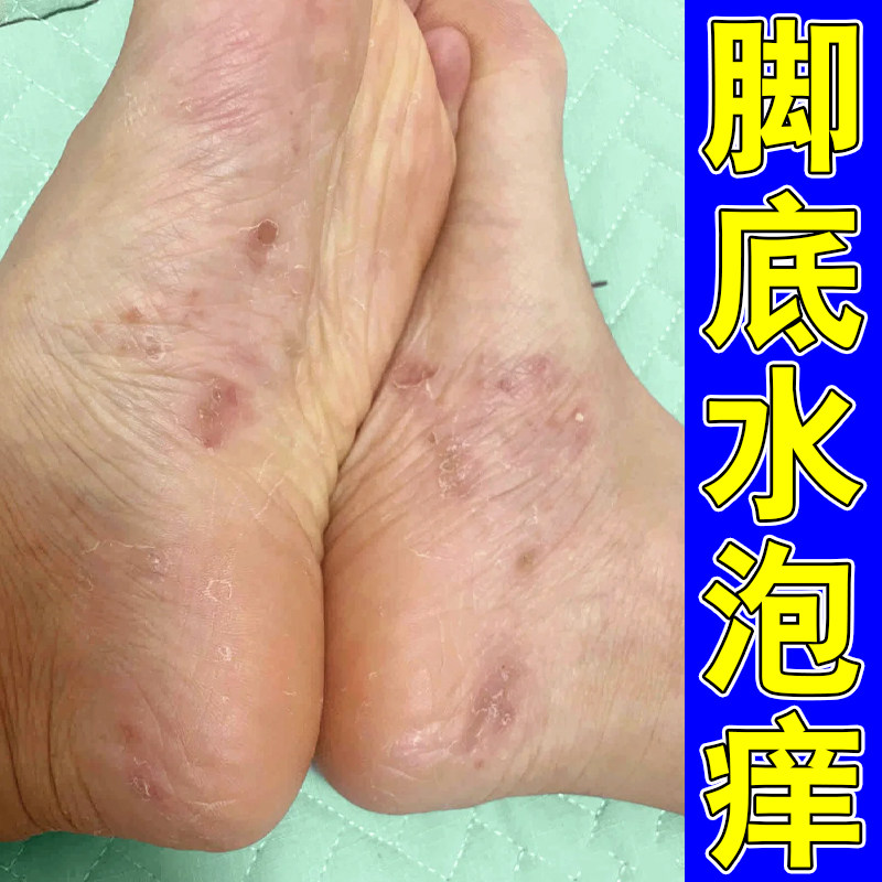 脚底脚起皮掉皮脚丫脚趾香港脚软膏