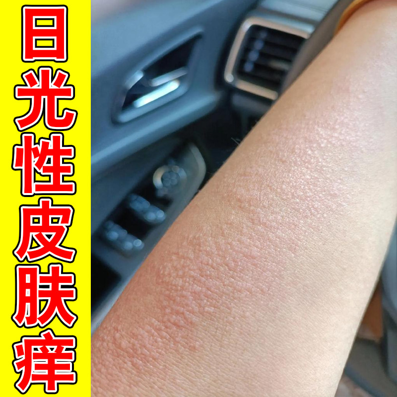 日光性皮肤痒夏天天气热紫外线过敏手臂痒胳膊上长小疙瘩水泡专用