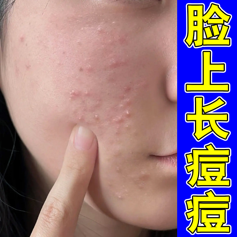 去脸上长痘痘毛囊堵塞闭口粉刺痘脸颊长下小疙瘩痘青春痘修复膏