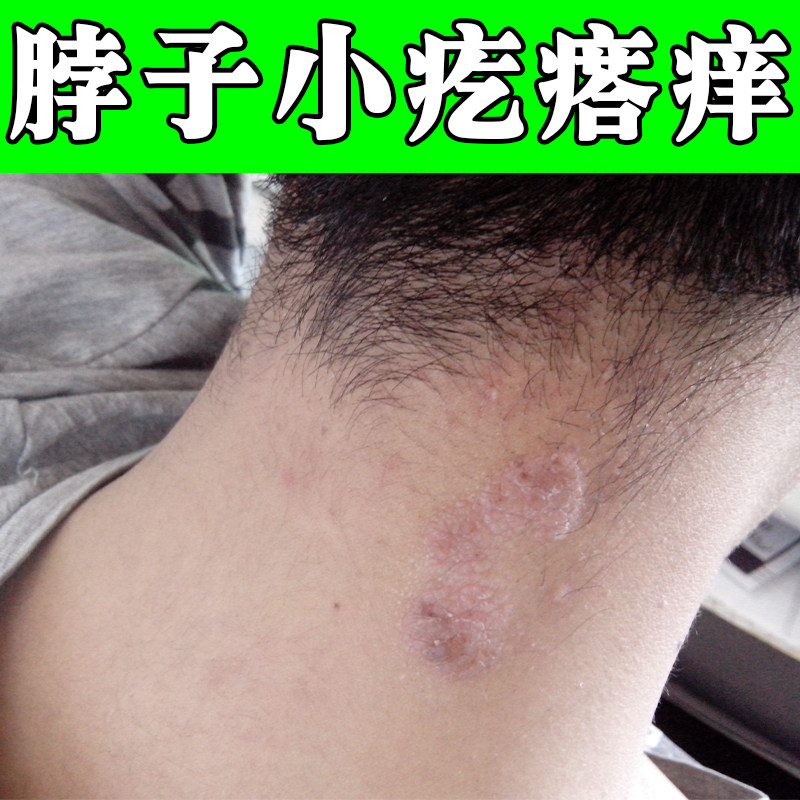 脖子后面痒脖圈刺挠起红斑疙瘩过敏痒颈部神经性皮肤痒专用软膏药