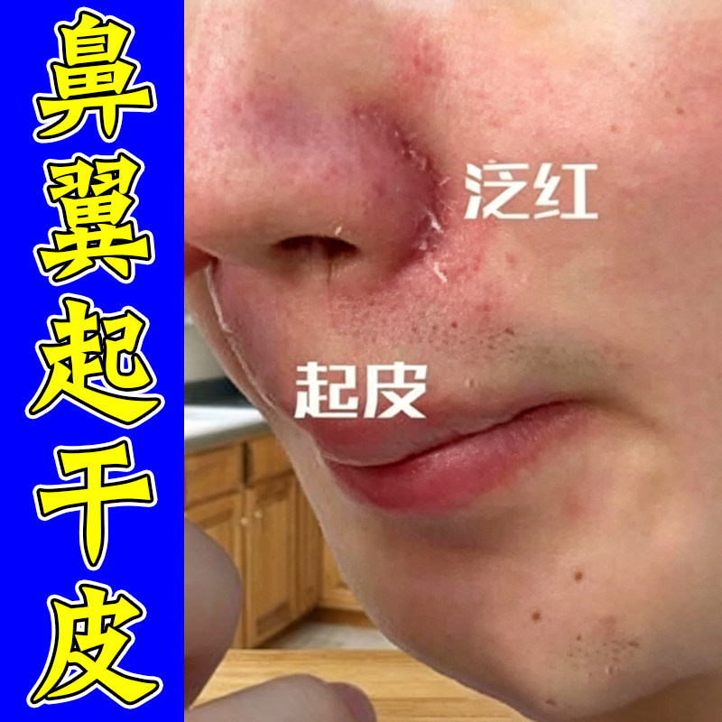 鼻翼起干皮发红干痒掉皮屑鼻子两侧泛红蜕皮长痘痒外用修复软膏