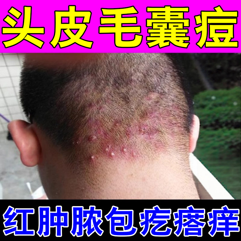 毛囊堵塞痘头皮毛囊红肿疙瘩头部脖子前胸后背马拉色菌痘痘的膏药