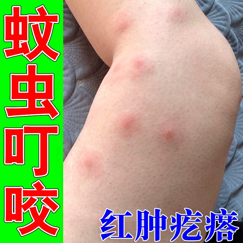 蚊虫叮咬起小点疙瘩婴儿宝宝成人蚊子包痒臭虫跳蚤螨虫叮咬膏药