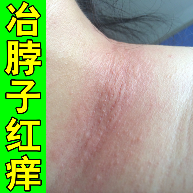 冶脖子红痒过敏长小疙瘩出汗颈部刺挠红斑干痒皮肤粗糙干燥专用膏