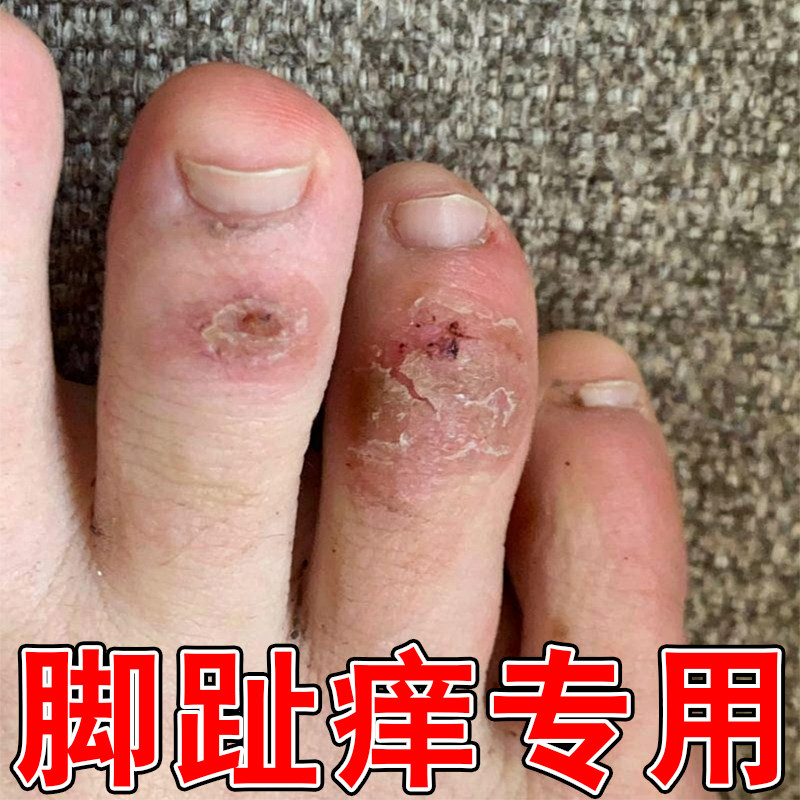 脚趾头痒专用修复药冶干燥粗糙起皮掉屑换季脚指关节脚趾增厚痒膏