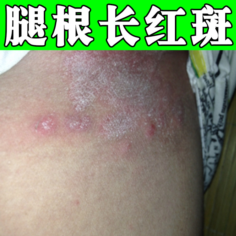 大腿内侧痒腿根长红斑干燥粗糙痒腿两侧潮湿男士股痒外用软膏