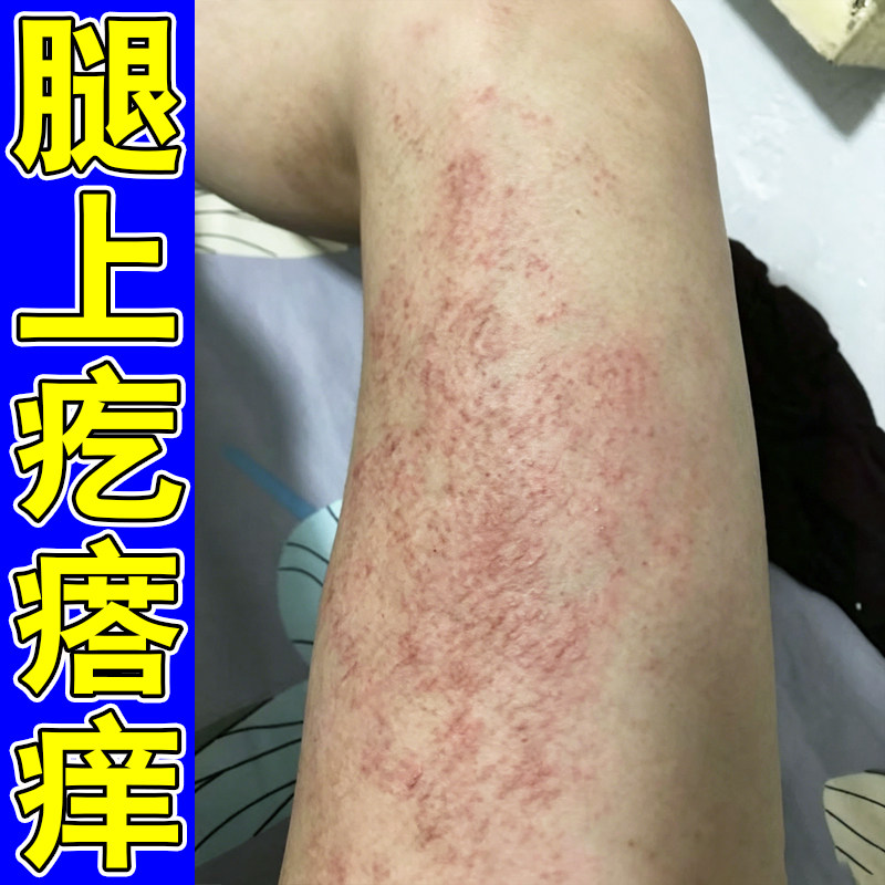 腿上疙瘩痒皮肤过敏大腿内侧痒季节性身上长小红点痒外用修复喷剂