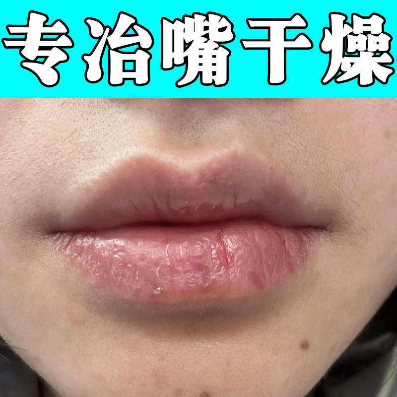 专冶嘴唇干起皮嘴巴脱皮掉干屑唇面干裂粗糙秋冬保湿唇部护理乳膏
