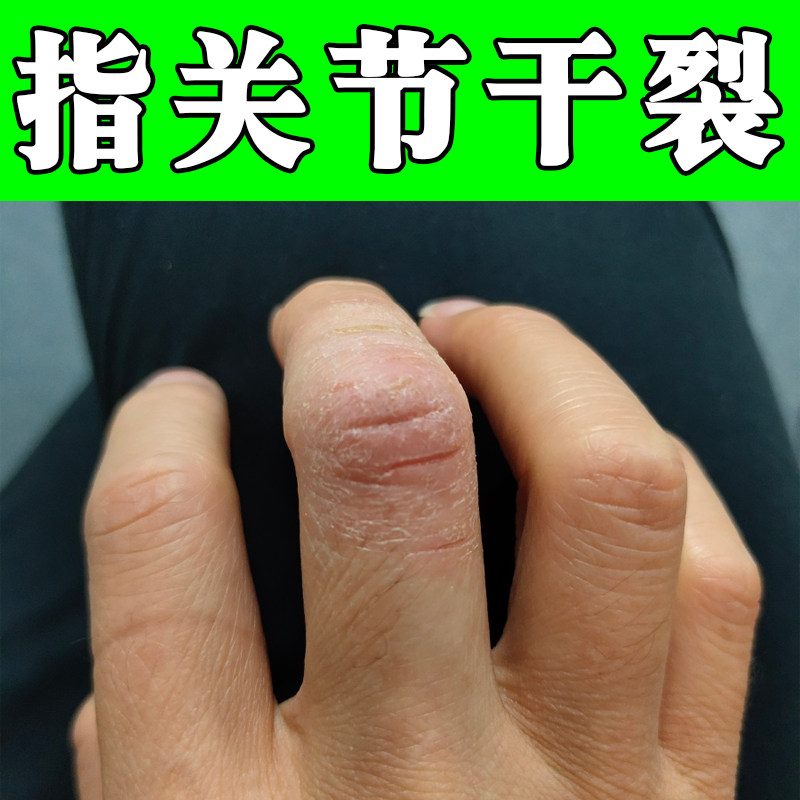 手指关节痒干裂起皮掉屑秋冬天手脱皮干燥粗糙真菌手裂口子软膏药