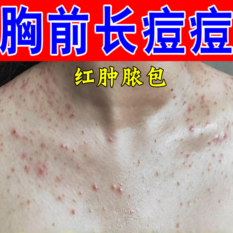 背后长痘痘后背毛囊痒胸前起红肿脓包疙瘩毛囊堵塞马拉色菌胸口痘