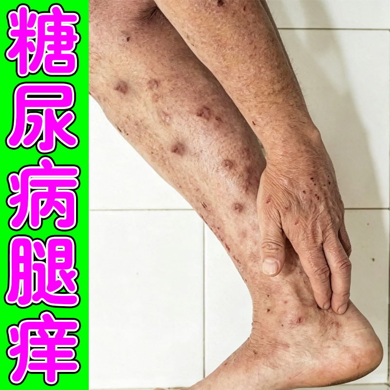 糖尿腿痒皮肤干燥脱屑痒小腿痒身上干痒粗糙一挠就痒结痂痒修复药