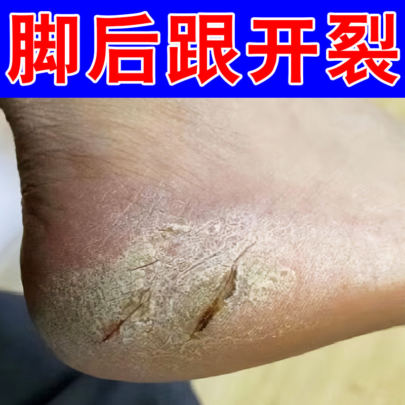脚后跟干裂起硬皮足跟开裂膏脚底干燥粗糙起皮掉屑手足干裂修复霜