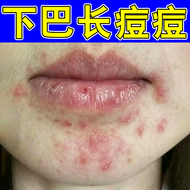下巴长痘痘红肿脓包硬块痘嘴周痘痘青少年熬夜上火闭口粉刺痘软膏