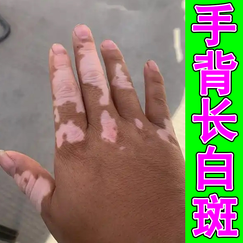 手背长白斑色素脱失真菌促进黑色素生长补骨脂酊手上起白斑