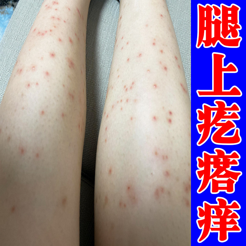 小腿皮肤痒专冶小红点的药腿部干痒起小疙瘩痘痘修复腿上皮肤痒药