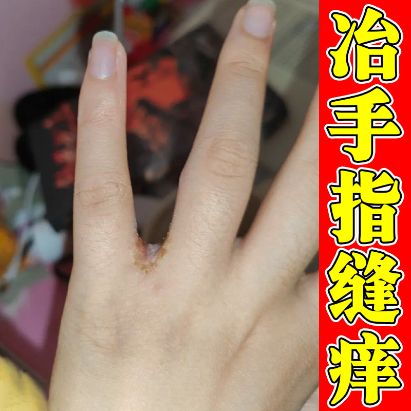 冶手指缝痒专用软膏指缝泛红经常碰水手指间开裂发痒手脱皮修复药