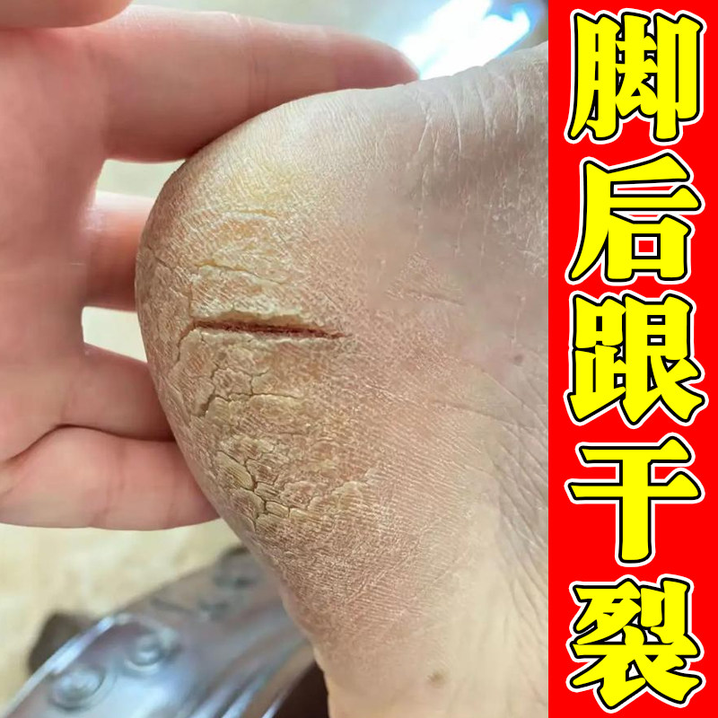 脚后跟干裂起硬皮足跟开裂起皮掉屑去死皮干皮粗糙干燥脚皮肤痒药