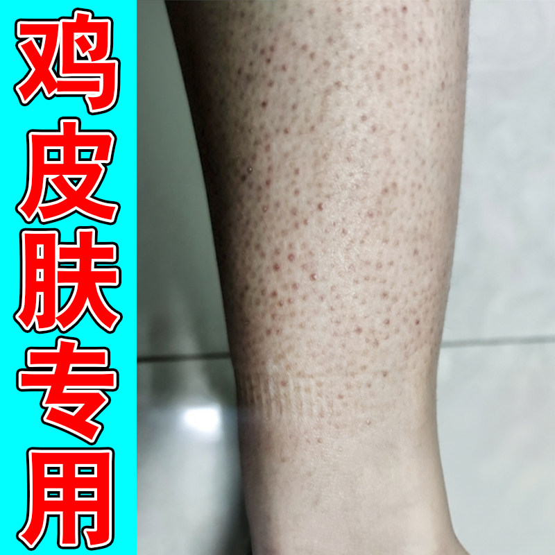 鸡皮疙瘩专用小腿大腿毛囊堵塞鸡皮膏凸起红色小颗粒毛周角化症药