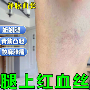 腿上红血丝毛细血管扩张引起红血丝久站酸麻胀痛蚯蚓腿膏