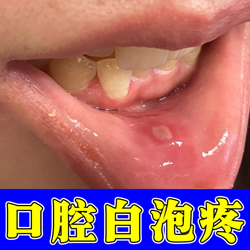 口腔疡用舌头疡火上起泡喷雾剂嘴巴上火起白泡外用