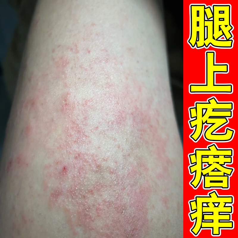 腿上红斑疙瘩痒干燥粗糙起小红点小腿过敏痒皮肤干痒专用修复软膏