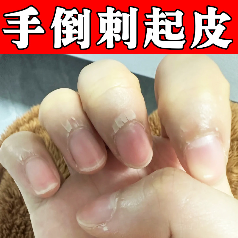 手倒刺起皮干燥指甲边缘有肉刺红肿疼痛防倒刺去死皮修复护理软膏
