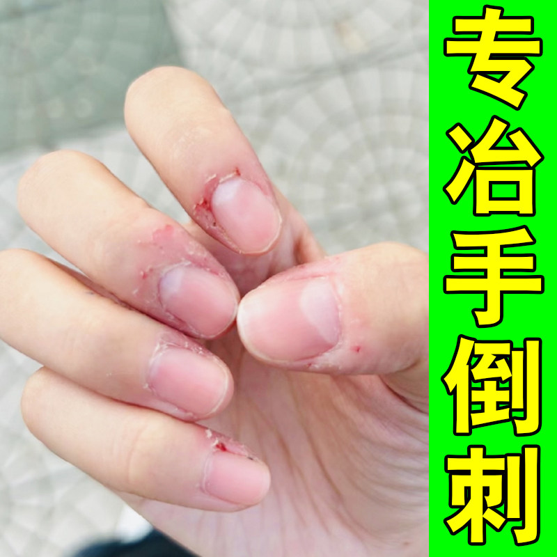 专冶手倒刺的药手指头起皮干裂去死皮手指甲边缘干裂有肉刺专用膏