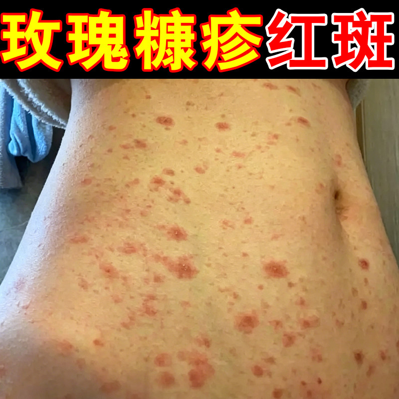 玫瑰糠专用膏药除红斑日光性皮紫外线过敏晒伤脂溢性红斑痒膏