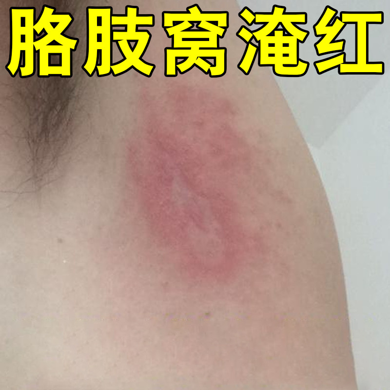 胳肢窝淹红出汗多刺挠痒腋下红斑小疙瘩防淹了红肿腋窝有异味 - 实物图