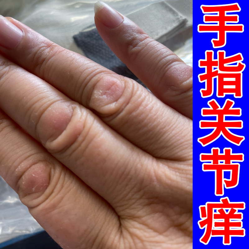 冶手指关节痒专用的软膏手起硬疙瘩干燥粗糙真菌手痒干裂修复药