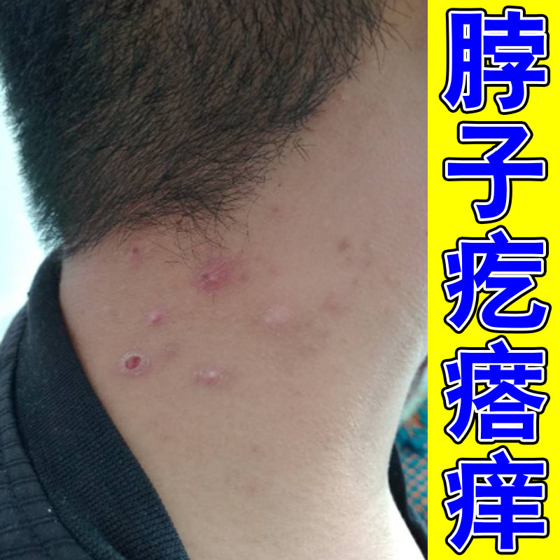 脖子后面痒长疙瘩痘外用药颈部过敏红斑干痒刺挠粗糙皮肤干燥痒膏