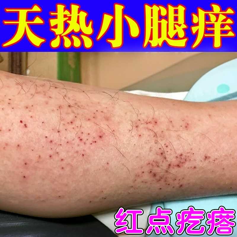 春夏腿痒天气热小腿皮肤干燥发痒湿过敏换季腿上起红点疙瘩乳膏