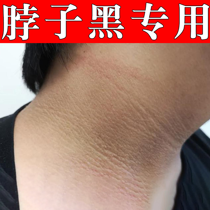 脖子黑色素去后脖颈黑黑的洗不干净除专用黑皮症沉淀按摩霜