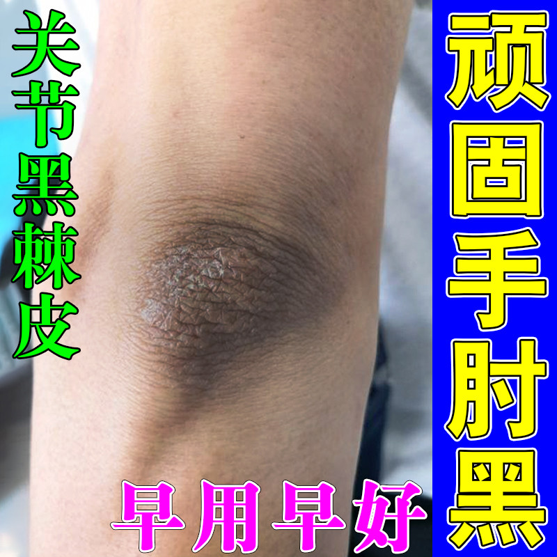 去胳膊肘黑死皮手肘干燥粗糙除脖子黑色素沉淀关节黑黑的洗不干净