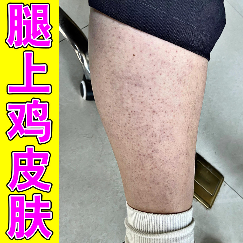 腿上鸡皮疙瘩专用修复毛周角化症药小腿手臂疙瘩长红丘颗粒鸡皮膏