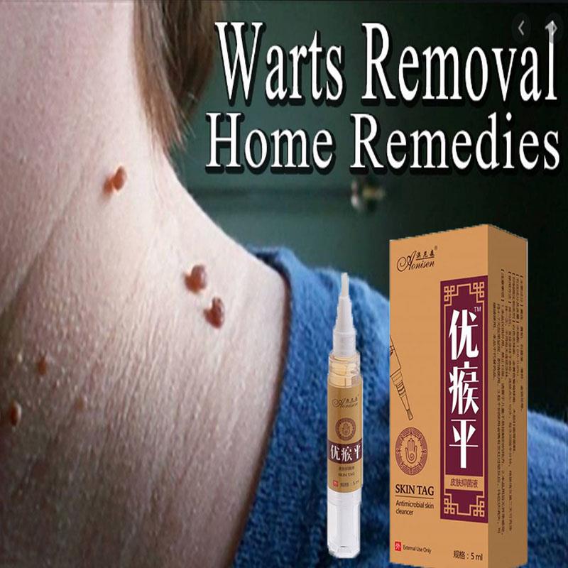 5M Skin Tag Remover Agat Mole& Genital Wart fast