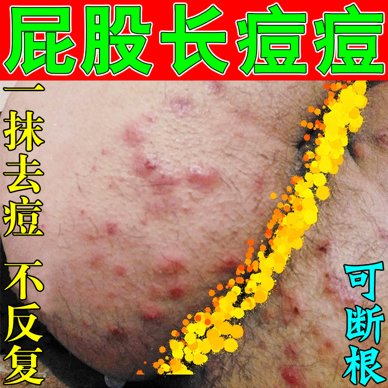 屁股上长疙瘩痒起痘痘久坐板疮湿痒脓包红肿硬块火疖子拔毒软膏