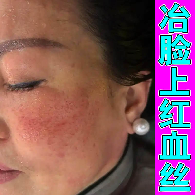 脸上红血丝修复角质层改善敏感肌肤增厚脸部红痒干燥起皮修复膏