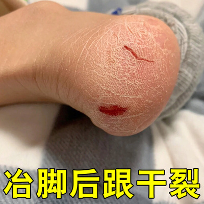 脚后跟干裂疼痛脚痒脚底板干掉皮开裂专用脚后跟开裂角质层增厚