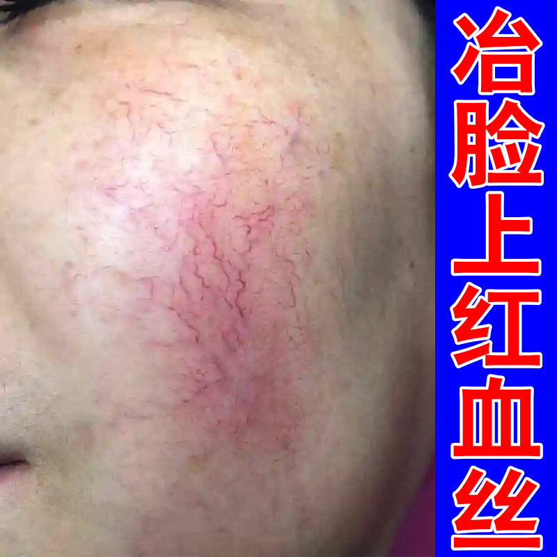 脸上红血丝脸部泛红角质层薄改善脸红敏感肌肤屏障受损脸部泛红
