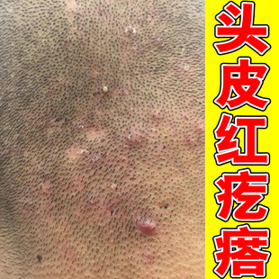 头皮长痘痘红肿头皮发痒真菌过敏干燥后脑勺起脓包痒痛修复乳膏