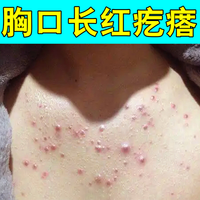 胸口长红疙瘩痘痘毛囊堵塞胸口起红疙瘩脓包专用草本乳膏胸前长痘