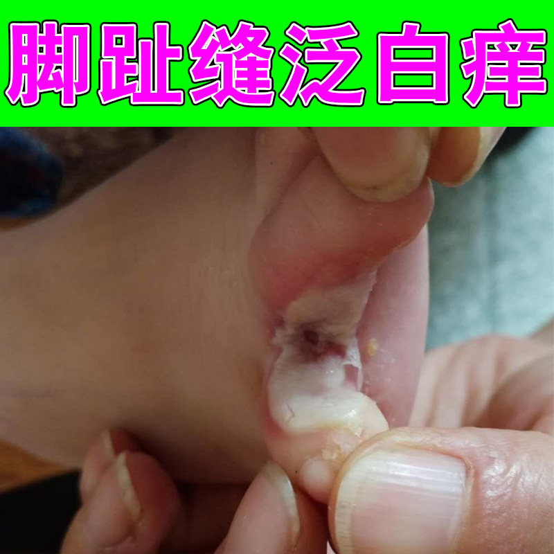 冶脚趾缝泛白发痒开裂脚气脚脱皮感染专用草本喷剂脚趾缝痒烂脱皮