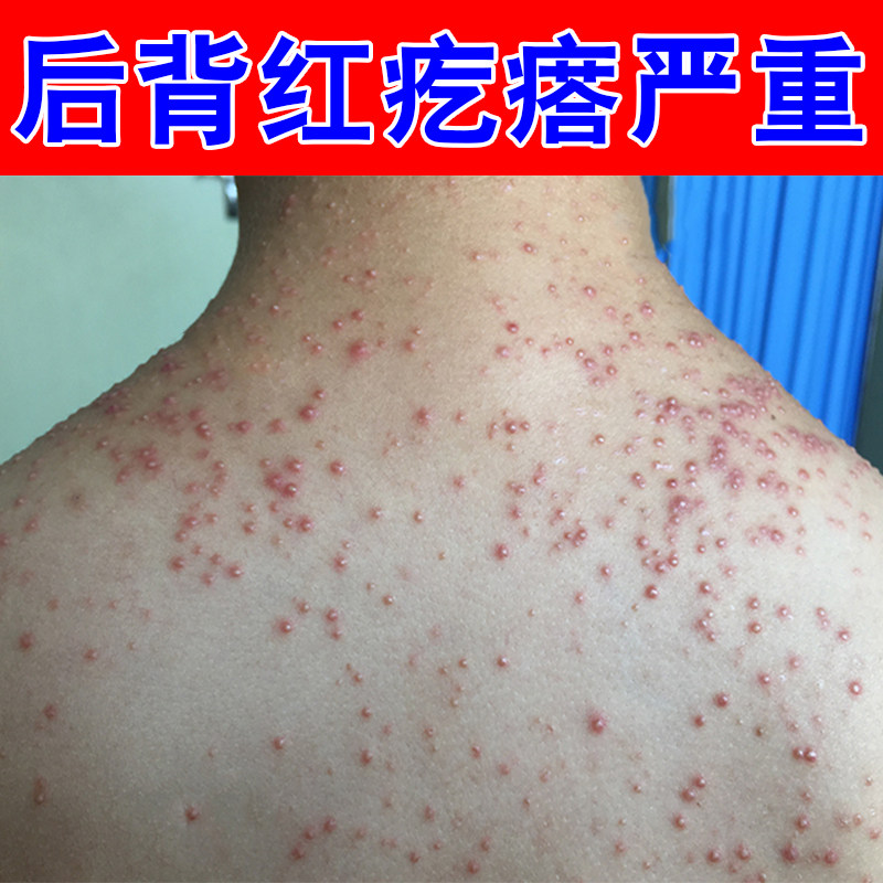 背后长痘痘后背红疙瘩毛囊堵塞胸前背部起红肿疙瘩痒皮肤过敏干痒