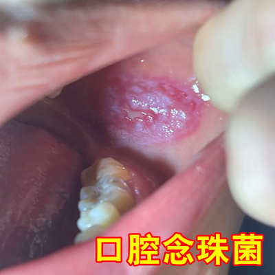 口腔念珠菌口腔异味难闻发白网状纹路糜烂溃烂滤泡增生长白斑专用