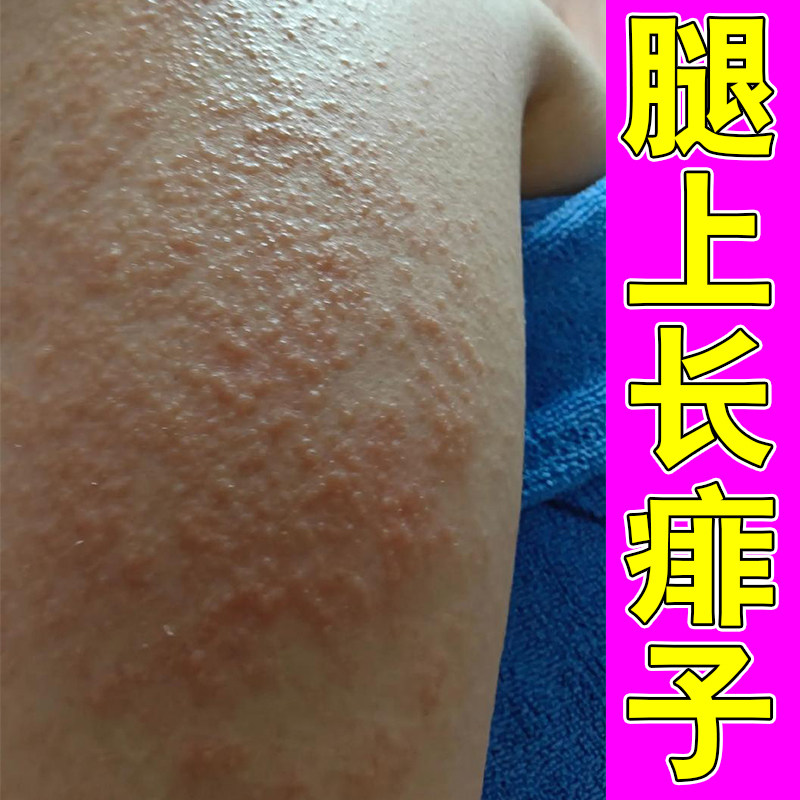腿上长痱子痒身上背部长痘痱子起红疙瘩治皮肤痒身上起红疙瘩过敏