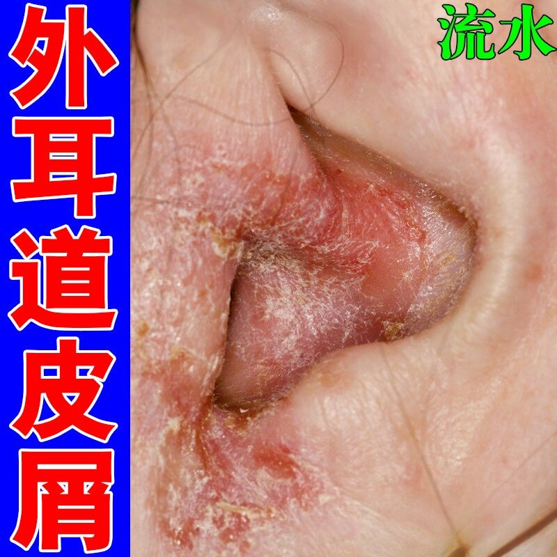 冶外耳道皮屑耳道感染耳朵发痒掉屑脱皮专用草本保湿修护软膏