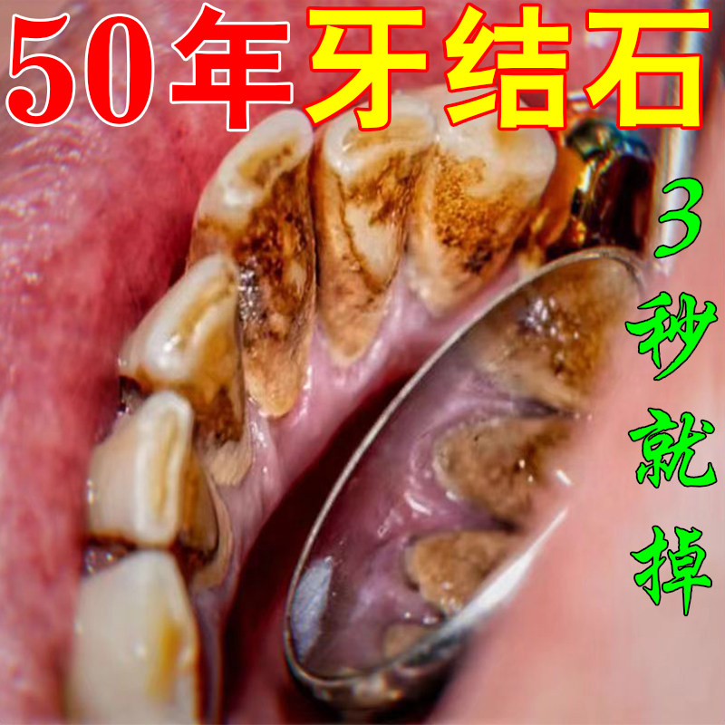 【牙斑净】牙上多年顽固牙渍抽烟牙黄快速美白牙齿去黄去牙渍口臭