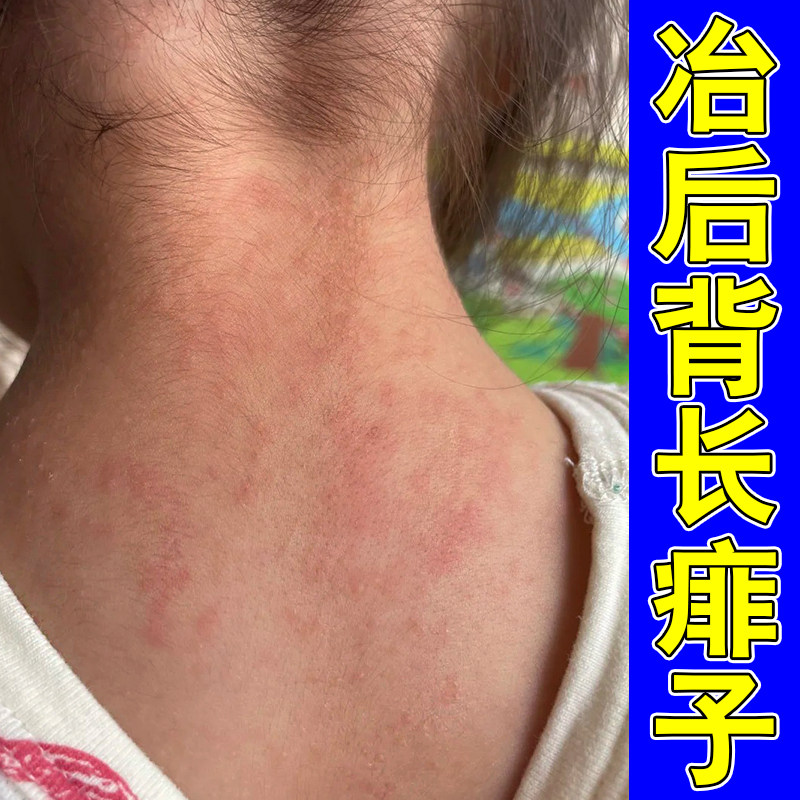 夏天脖子出汗长痱子红痒刺挠皮肤过敏天热长痱子红疙瘩专用喷剂